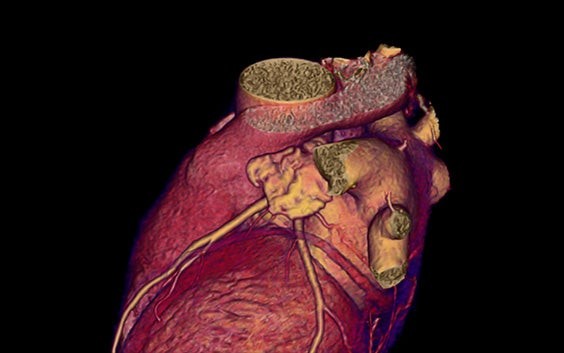 3D volume rendering of a heart