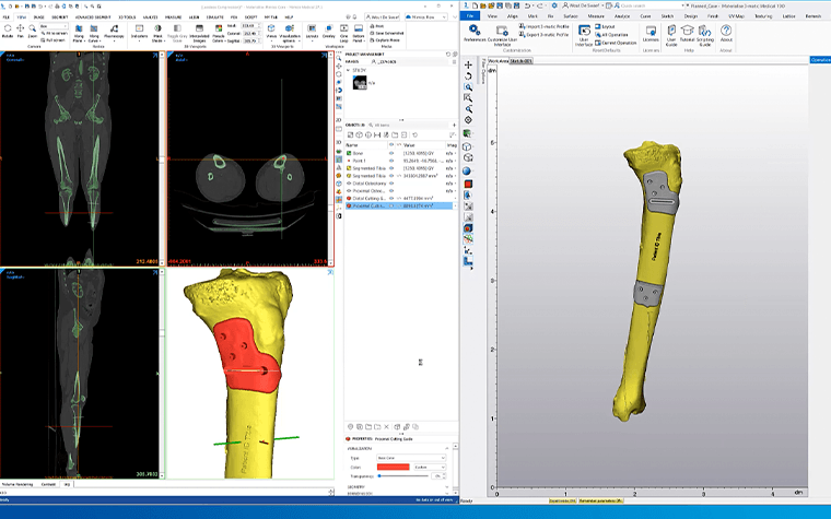 Screenshot of Materialise Mimics with patient scans and a model of the patient's bone with personalized surgical guides