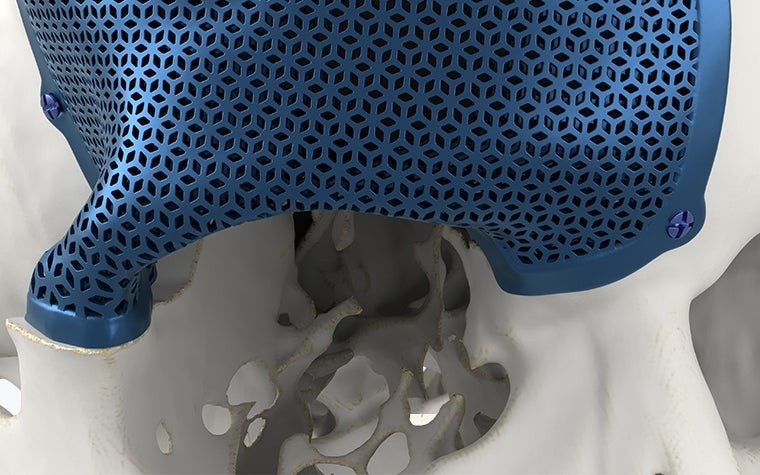Close-up view of a porous, titanium, 3D-printed, CMF implant