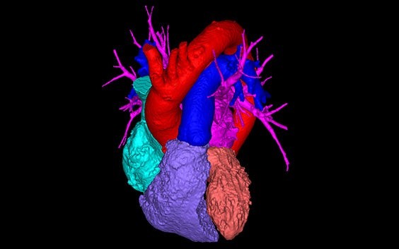 3D-CT planning view of a heart with sections in different colors