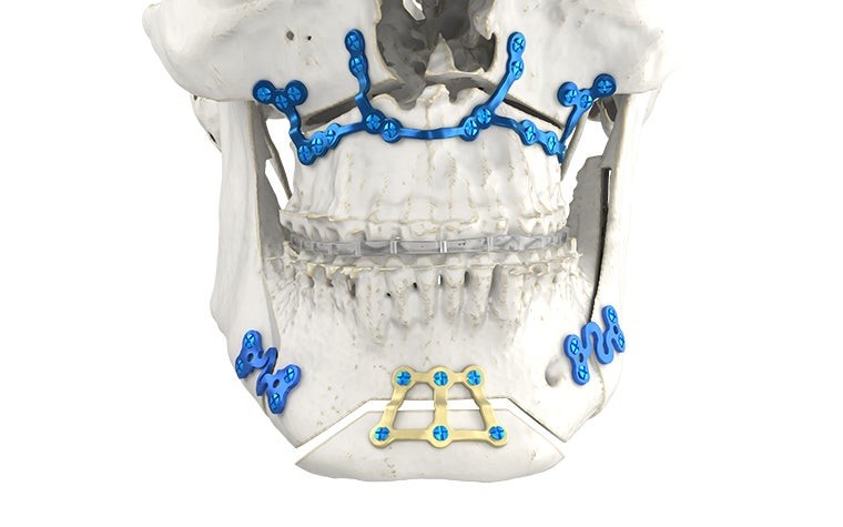 Jaw of a skull showing a combination of an orthognathic splint and standard plates