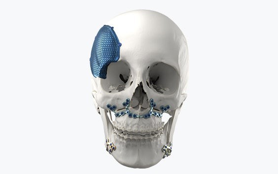 Model of a skull with metal, personalized implants attached