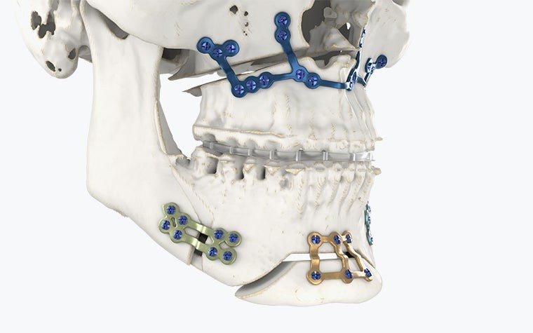 Lower half of a skull with 3D-printed splints and implants