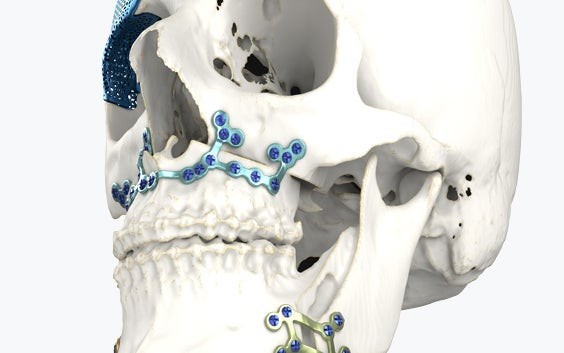 Schräge Ansicht eines Schädelmodells mit 3D-gedruckten Implantaten