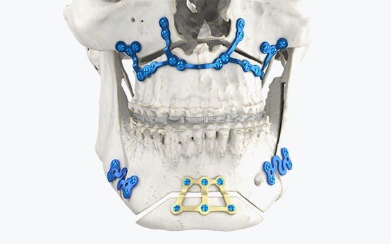 Bottom half of a skull model with metal splints