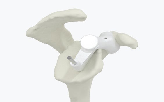Scapula bone model with a personalized guide attached