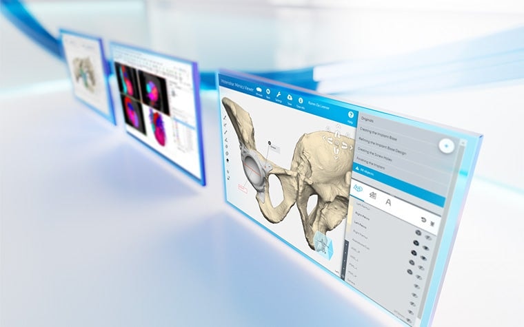 Three screens showing patient anatomy within software from the Materialise Mimics platform on a white reflective background with blue lines