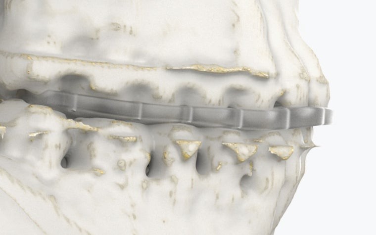 View of orthognathic splints on a bone model