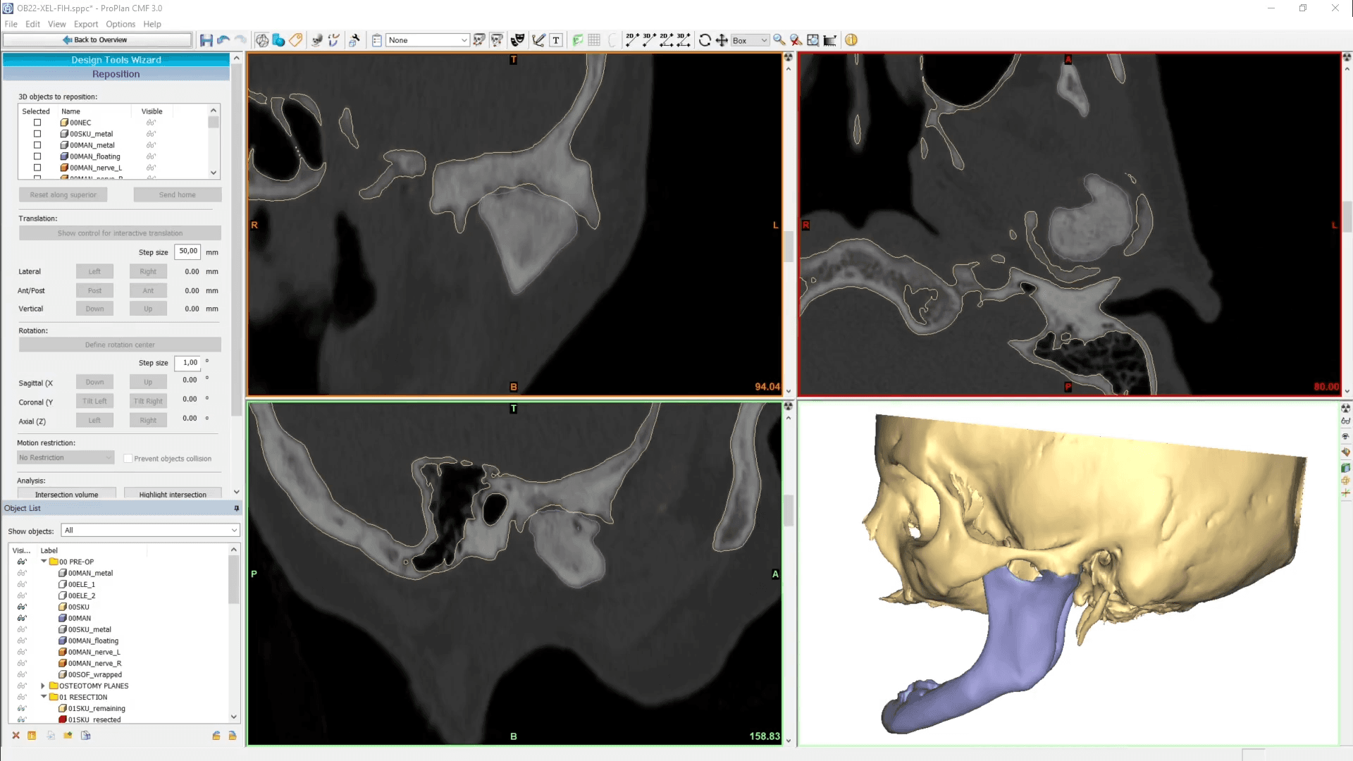 Example of a virtual surgical planning session for a personalized TMJ implant.